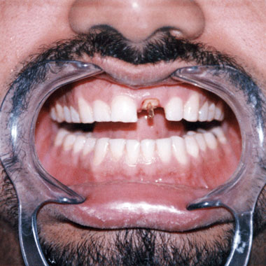 Dental Bridges in Muscat Oman